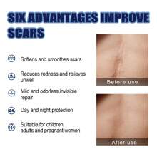 Scar Cream Scars, Pregnancy Surgery Scars, Skin, Skin Cream